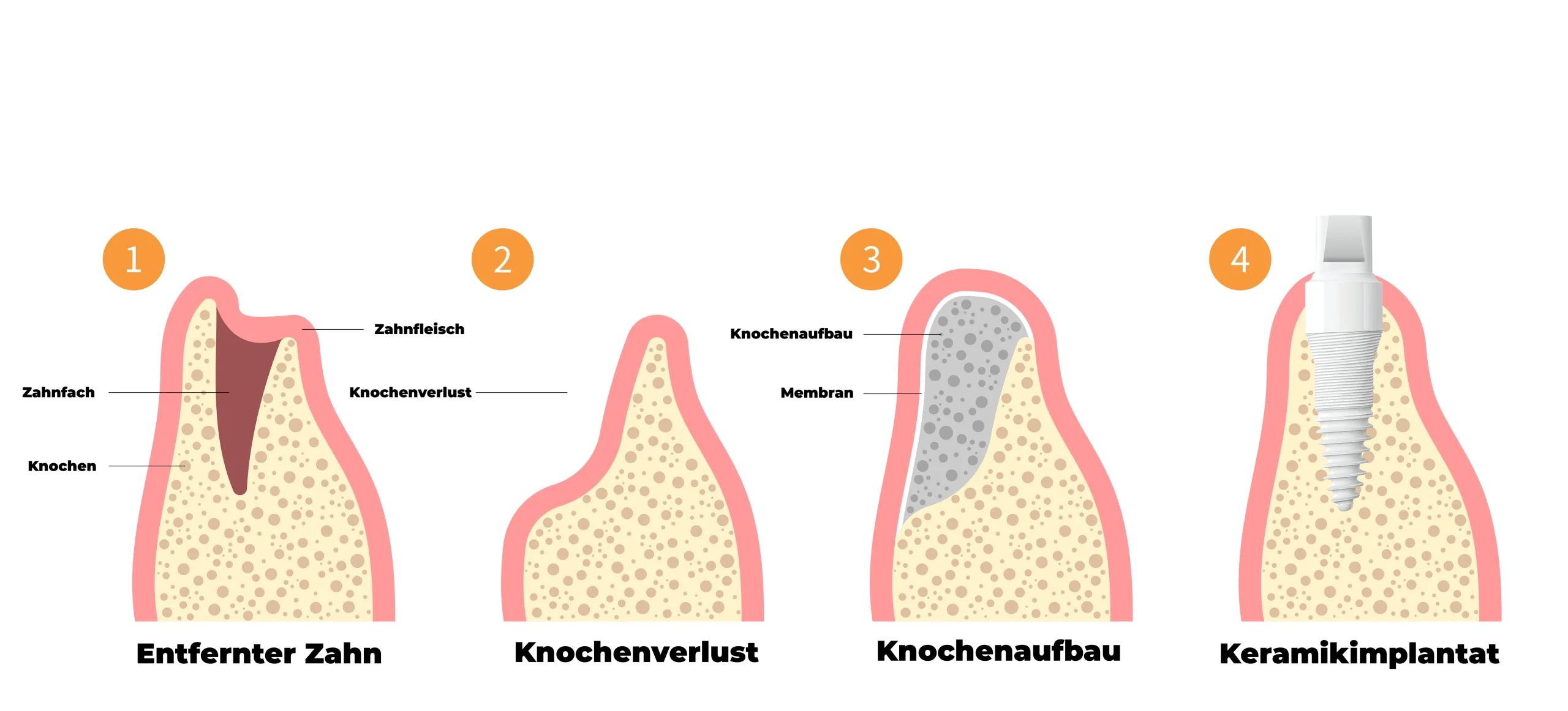 Bone regeneration concept in biological dentistry