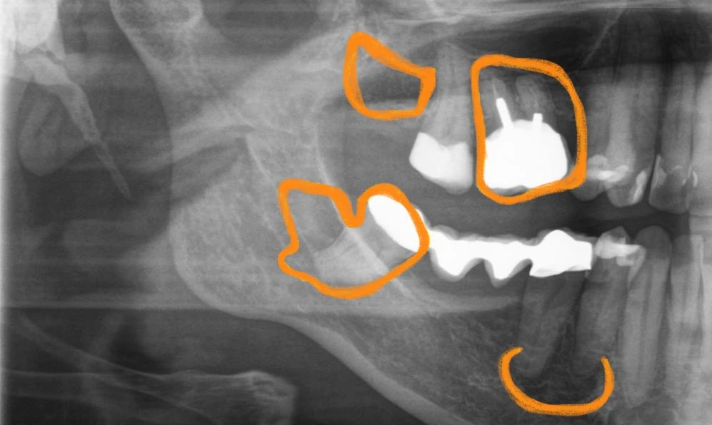3D imaging revealing potential interference fields and hidden inflammation in the jawbone