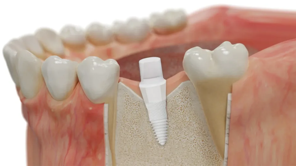 Illustration of a white ceramic implant placed in the jawbone between two natural teeth