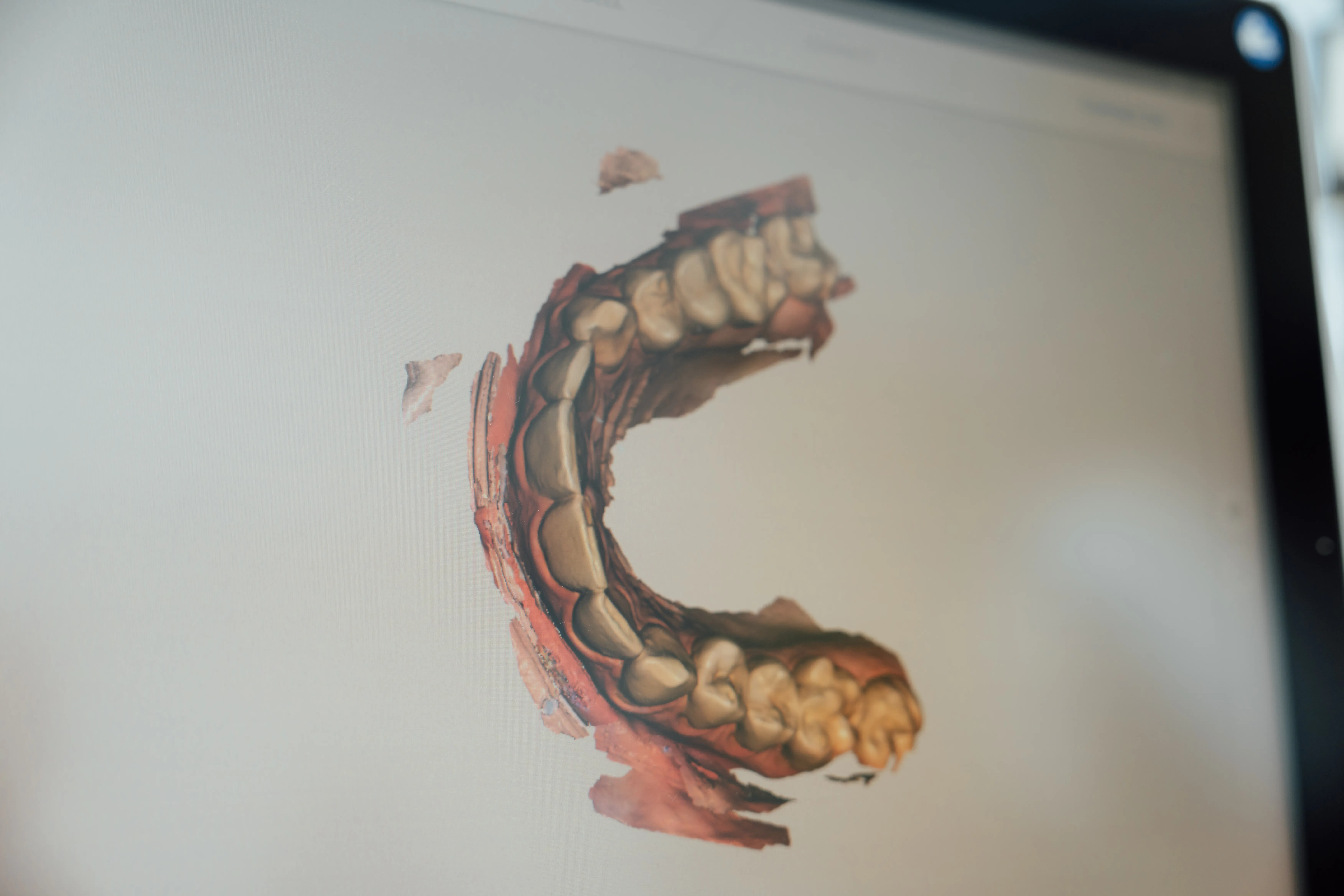 Natural teeth whitening